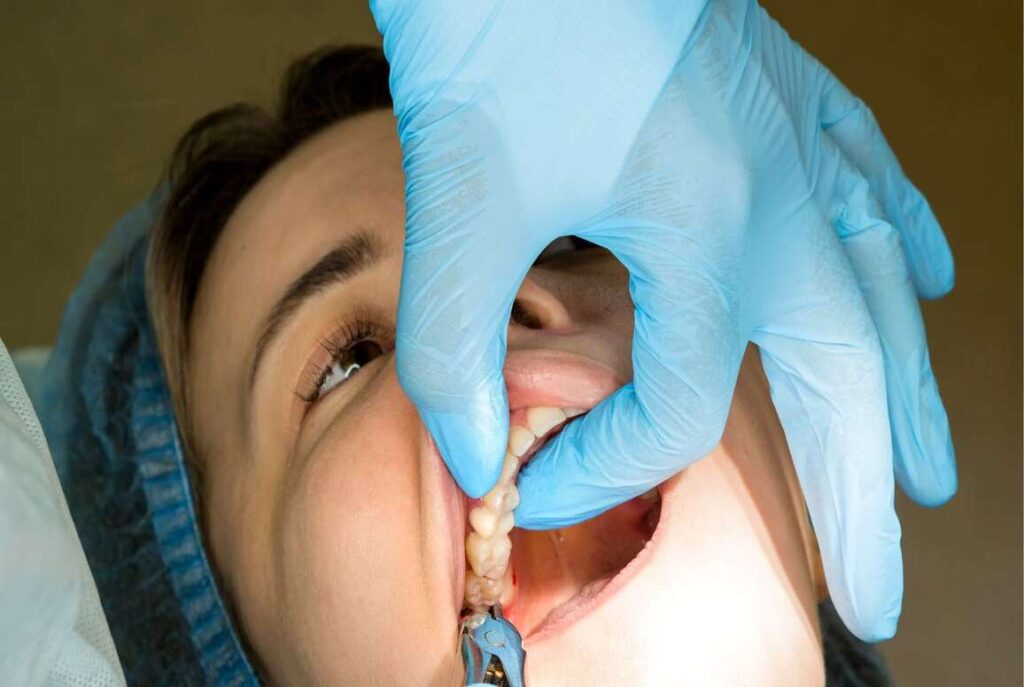 Surgical Extractions treatment at Star Dental Care